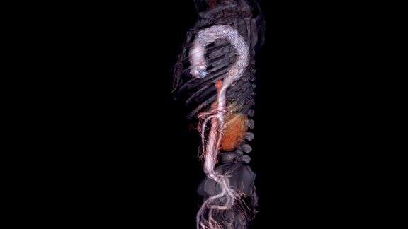 CTA腹主动脉三维渲染图像透明的骨骼显示主动脉夹层