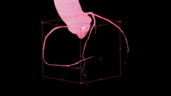 CTA冠脉三维渲染图像在屏幕上旋转用于冠脉狭窄的血管诊断