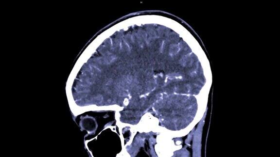 CTA脑或ct血管造影的脑矢状面视图3D渲染图像显示人脑血管