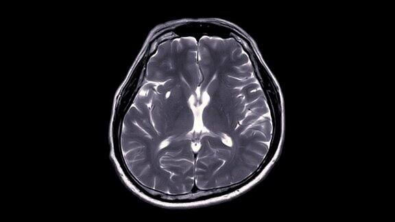 大脑MRI