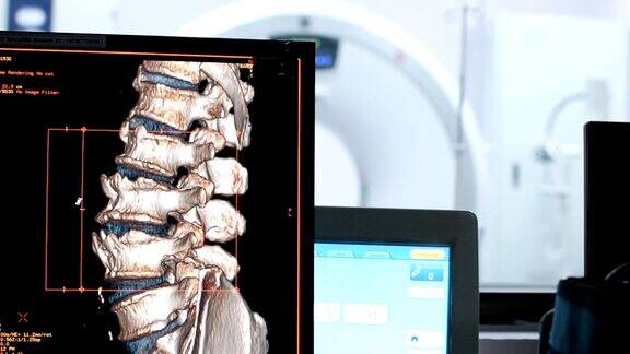 CT扫描显示腰椎骨折的计算机图像