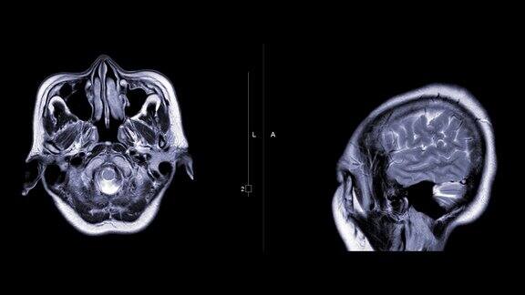 MRI大脑或磁共振成像(MRI)的大脑比较轴向和矢状面钆造影剂