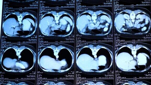 胸部腹部计算机断层扫描(CT)医学、科学和教育CT背景