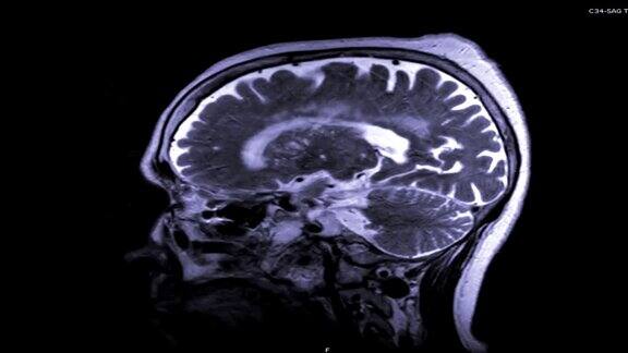 脑矢状面造影剂磁共振成像脑磁共振成像