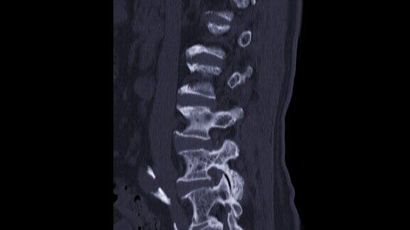 CT脊髓造影术