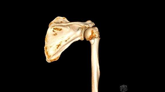 左肩CT三维显示肱骨骨折头