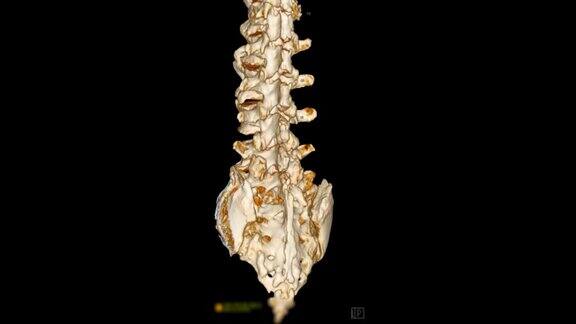腰椎三维CT扫描