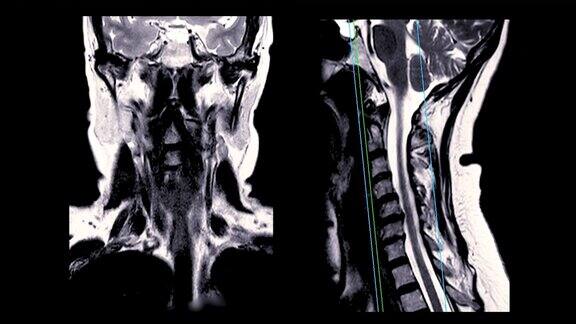 颈椎MRI