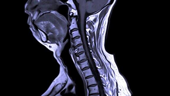 颈椎或颈椎侧视图的MRI