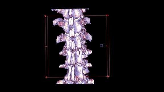T-L脊柱CT扫描或胸腰椎交界处脊柱3D渲染图像在屏幕上旋转显示L1脊柱骨折