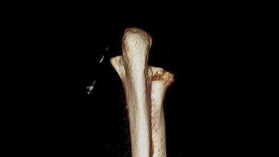 肘关节CT扫描三维渲染图在屏幕上翻转