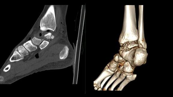 踝关节或右踝关节CT扫描二维矢状面和三维渲染显示骨折距骨
