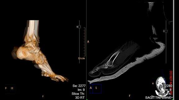 CT足部或双足扫描3D渲染图像对比3D图像和2D矢状面显示胫骨远端骨折