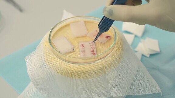 毛囊在杯子的特写脱发的治疗头发移植外科医生在手术室进行头发移植手术将毛囊从身体的某一部分移出的外科技术