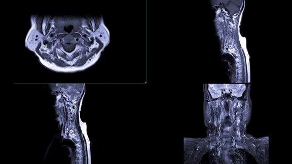 颈椎MRIC-spine或MRI图像轴向、冠状面和矢状面显示脊椎病和压缩性骨折