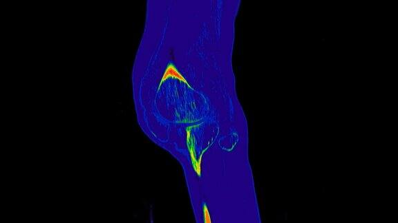 膝关节彩色模式矢状位CT扫描