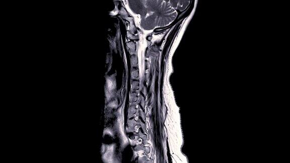 颈椎MRI