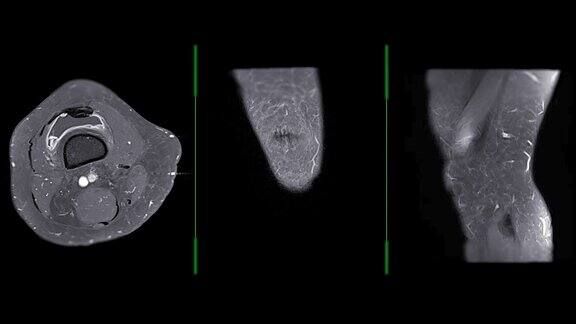 膝关节MRI或膝关节MRI轴位、冠状位、矢状位T1脂肪抑制注射钆检测膝关节肿瘤