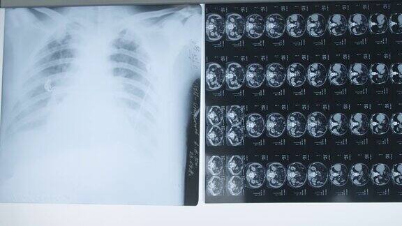 手术室墙上的x光片