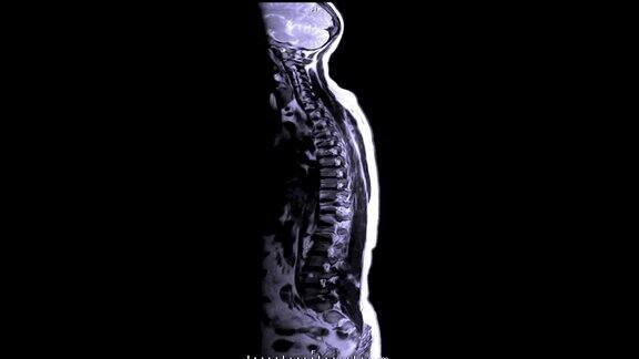 全脊柱MRI:显示脊柱受压脊髓(脊髓病)