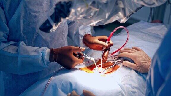 手术过程一组外科医生在手术室里给一个病人做手术医生手中的医疗器械特写镜头