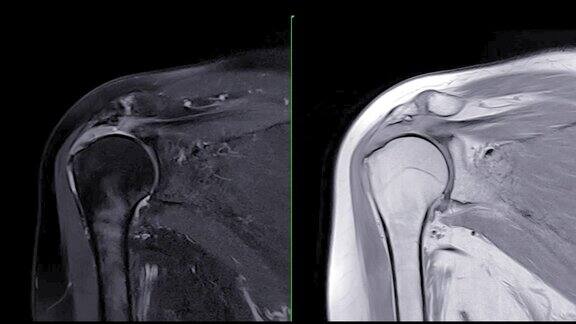 肩关节冠状位T2FS和PDW的磁共振成像或MRI诊断肩关节疼痛