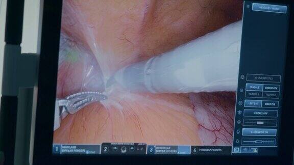 外科医生在使用医疗机器人进行腹腔镜手术时看着监视器而护士则在做他们的工作特写镜头