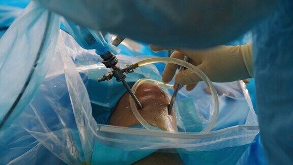 外科医生对膝盖骨进行内镜操作医生在膝关节做关节镜手术在手术室使用现代关节镜工具