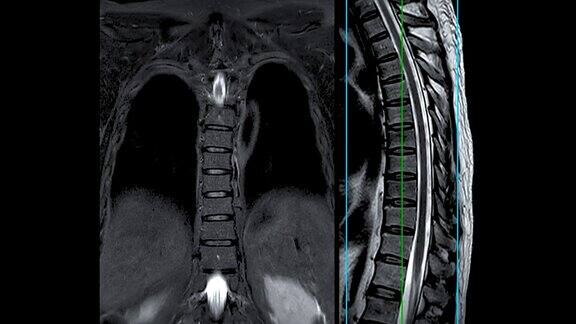MRIT-L脊柱或胸椎冠状位和矢状位T2技术与参考线诊断脊髓压迫