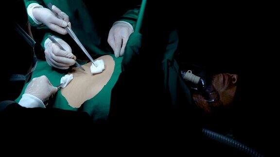 4K特写医生助理的手拿着钳那里有一块布吸血需要手术的服务以便为在床上失去意识的病人做手术