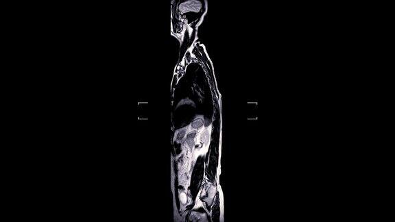 MRI扫描全脊柱