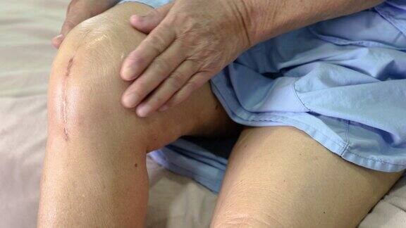 亚洲老年妇女患者显示疤痕手术全膝关节置换术缝合伤口手术关节置换术在医院床上健康强医学观念