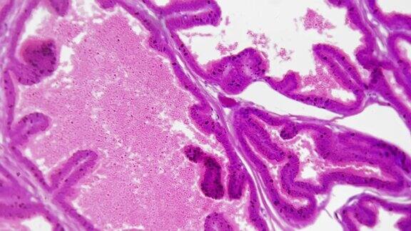 白色背景下400倍显微镜下摄人前列腺切片