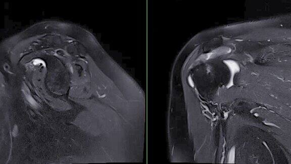 肩关节矢状位和冠状位T2FS的磁共振成像或MRI诊断肩关节疼痛