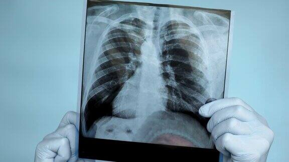 特写在手术室里医生手里拿着一张肺部的x光片医生在医院里仔细分析病人肺部的x光片超声显示肺损伤肺炎健康