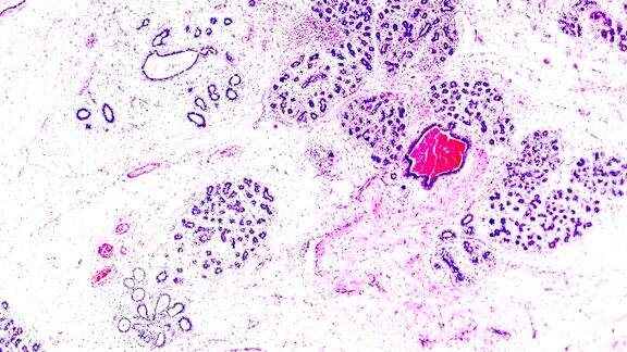 乳癌在光镜下的不同区域变焦