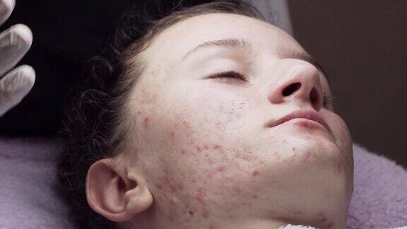 皮肤科医生正在检查一位有痤疮问题的年轻女子的皮肤脸上的伤痕