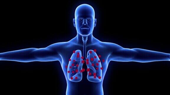人类肺部感染冠状病毒或病毒由病毒引起的呼吸道感染NcovCovid19Ncov2019