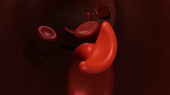 血管内流动的镰状细胞性贫血