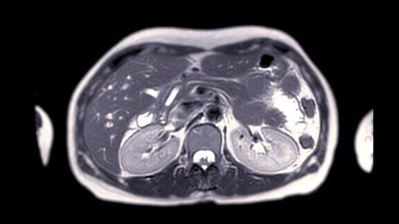 MRI上腹部诊断肝肿瘤或肝细胞癌
