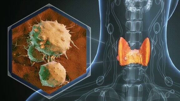 妇女的甲状腺癌