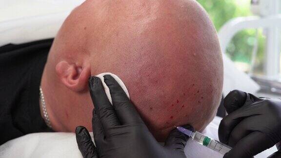 与毛发学家在光疗过程中光头男性的特写后视图青绿色的背景秃顶和专业的治疗