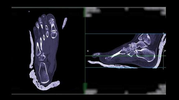 足部冠状位和矢状位CT扫描诊断骨折