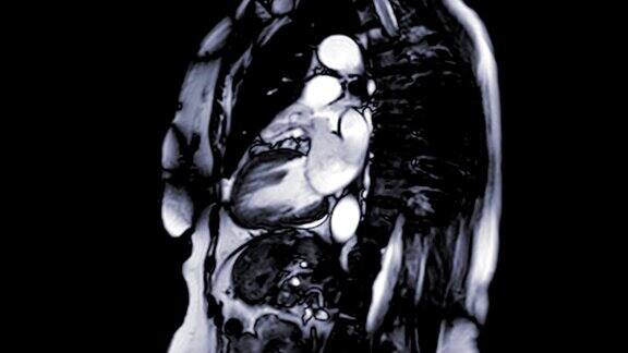 心脏MRI或心脏MRI(磁共振成像)在垂直长轴视图显示心脏工作用于检测心脏病
