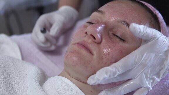 年轻女子接受痤疮治疗皮肤科医生与特殊的面部酸在皮肤科办公室