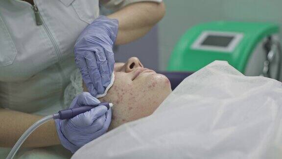 Cosmetological程序操作医生治疗有青春痘和痤疮的问题皮肤激光健康皮肤