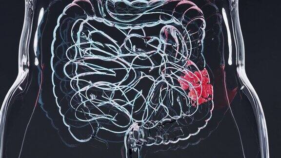 肠癌或结直肠癌、结肠癌、肠炎性疾病、肠痛、乳糜泻、感染、复制、细胞扩张、恶性癌、病毒、3d渲染