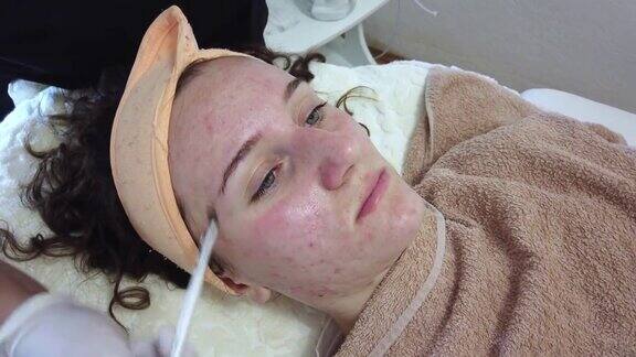 患有痤疮的年轻女孩在皮肤科办公室或美容院接受面部治疗使用洁面泡沫清洁毛孔