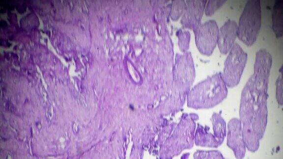 卵巢囊腺瘤不同部位光镜下活检