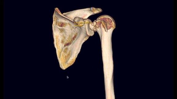 左肩CT扫描三维图像显示肱骨骨折头